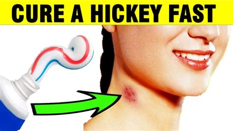 how to get rid of a hickey fast tiktok|love bite mark on neck.